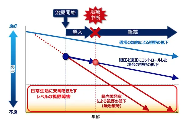 緑内障 | さいたま新都心眼科